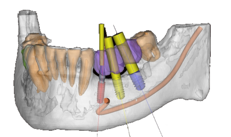 implant planning